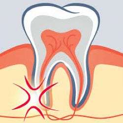 Featured image for “What is a Root Canal and What Can I Expect During the Procedure?”