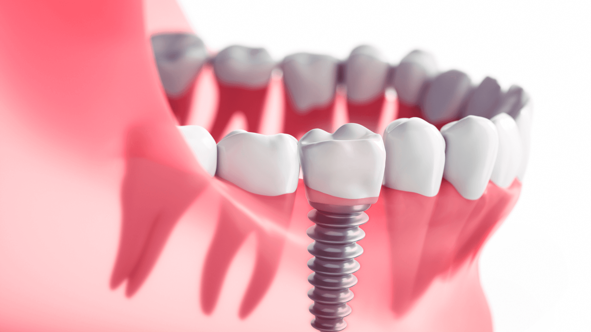 Featured image for “Do Dental Implants Hurt?”