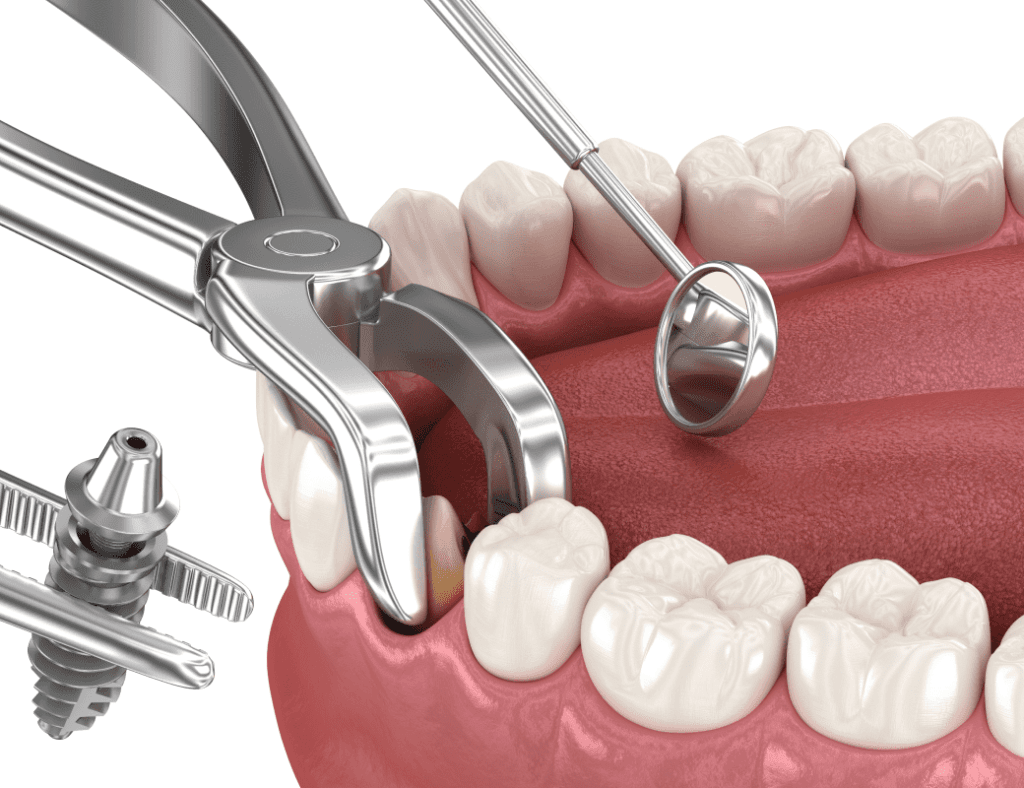 When to Stop Using Gauze After Wisdom Tooth Extraction 1