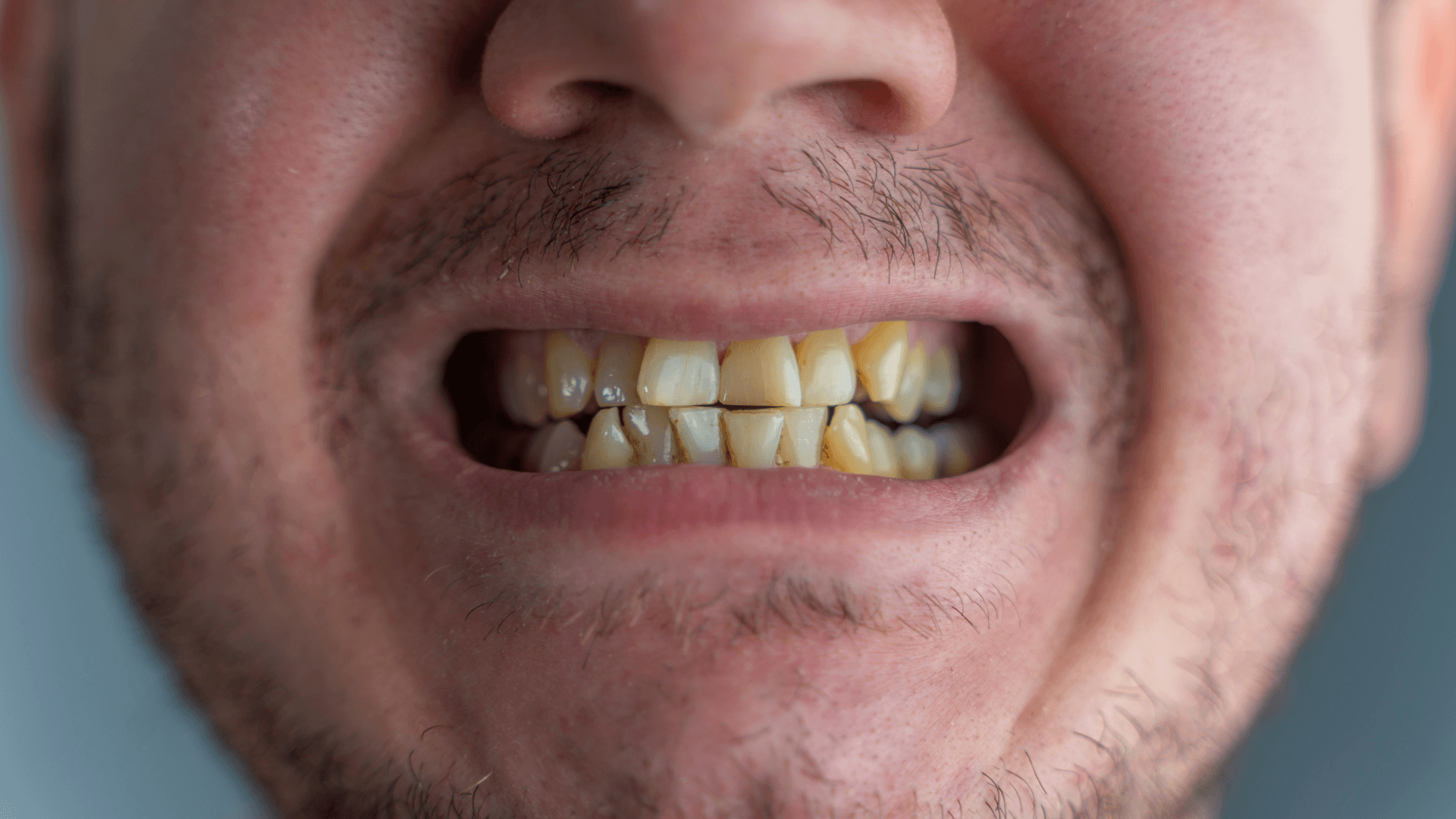 Featured image for “Why Do Teeth Turn Black? Causes, Treatments, and Prevention ”