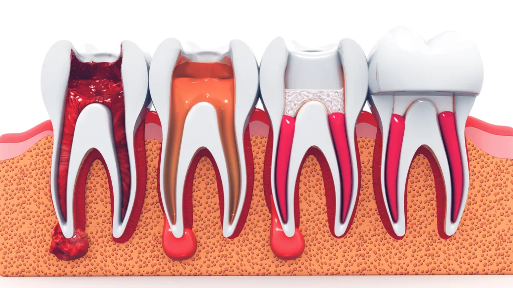 Can Dentist Perform Root Canal