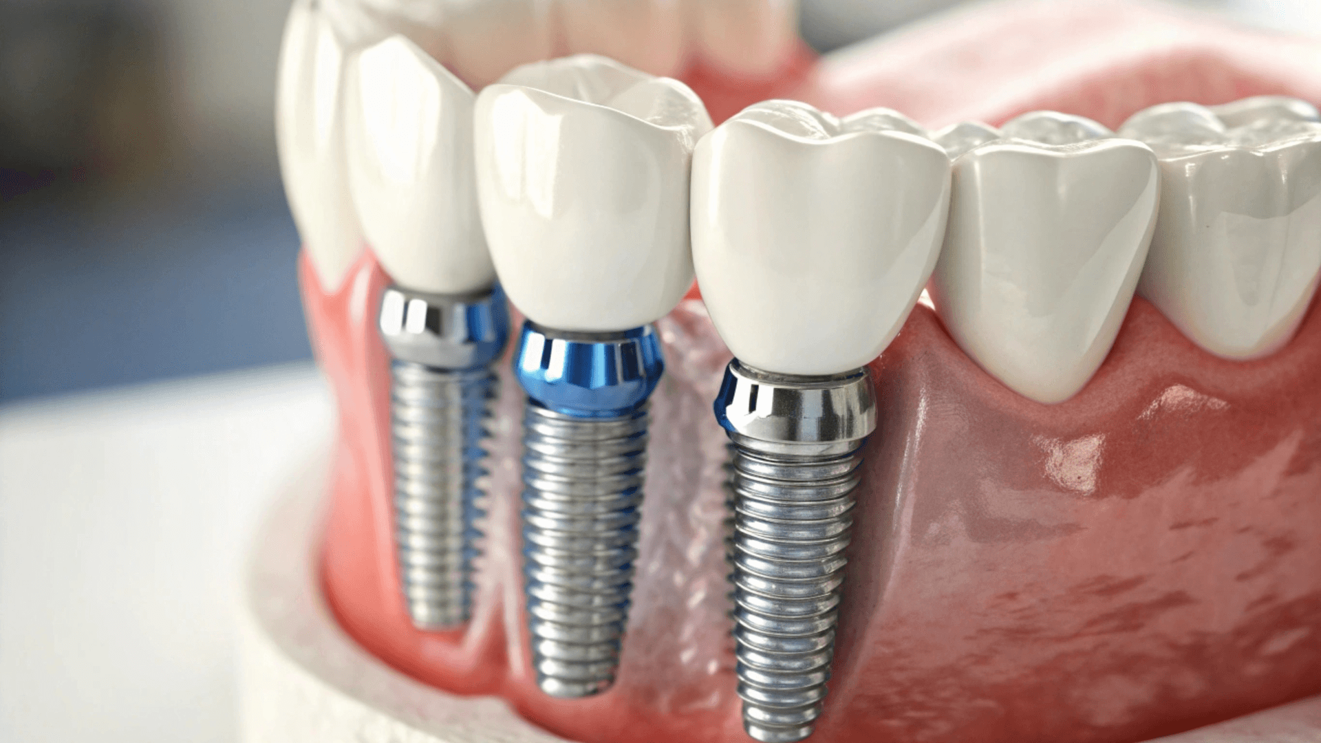Featured image for “Dental Implants: Step-by-Step Procedure”