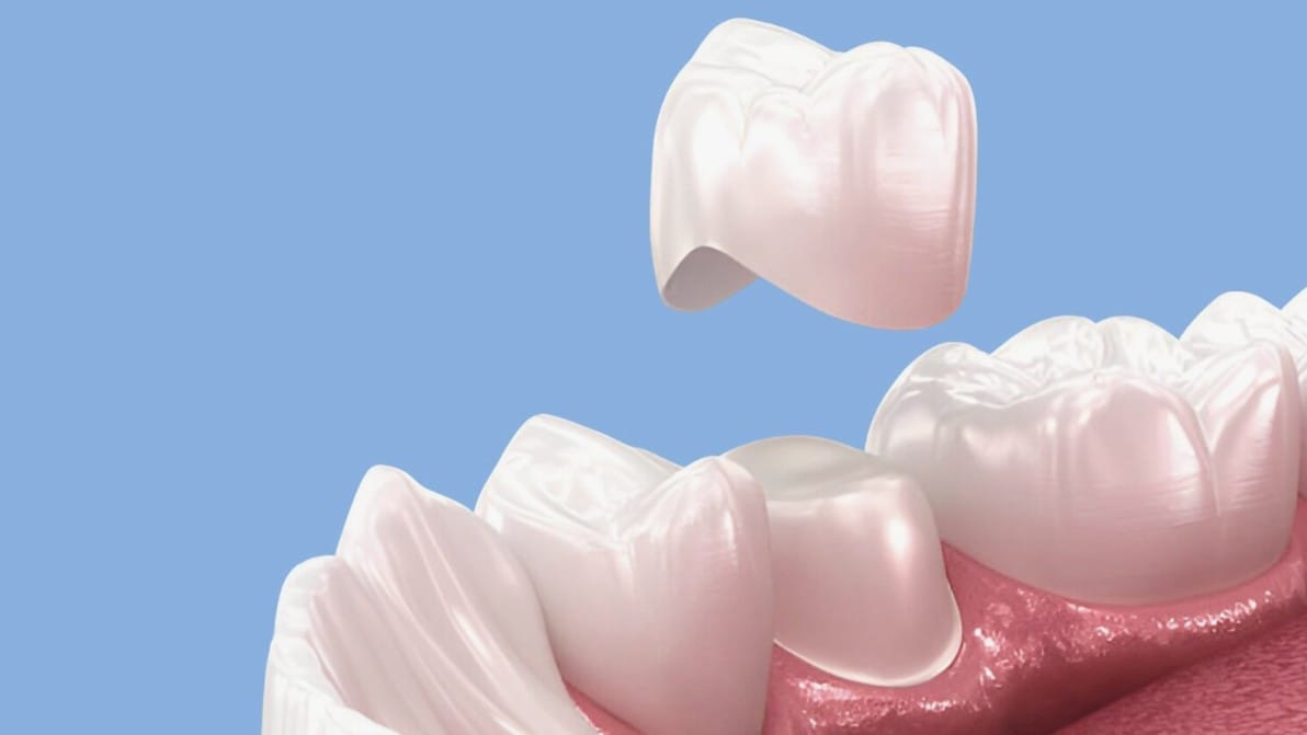 Featured image for “Why Does My Dental Crown Hurt When I Put Pressure On It?”