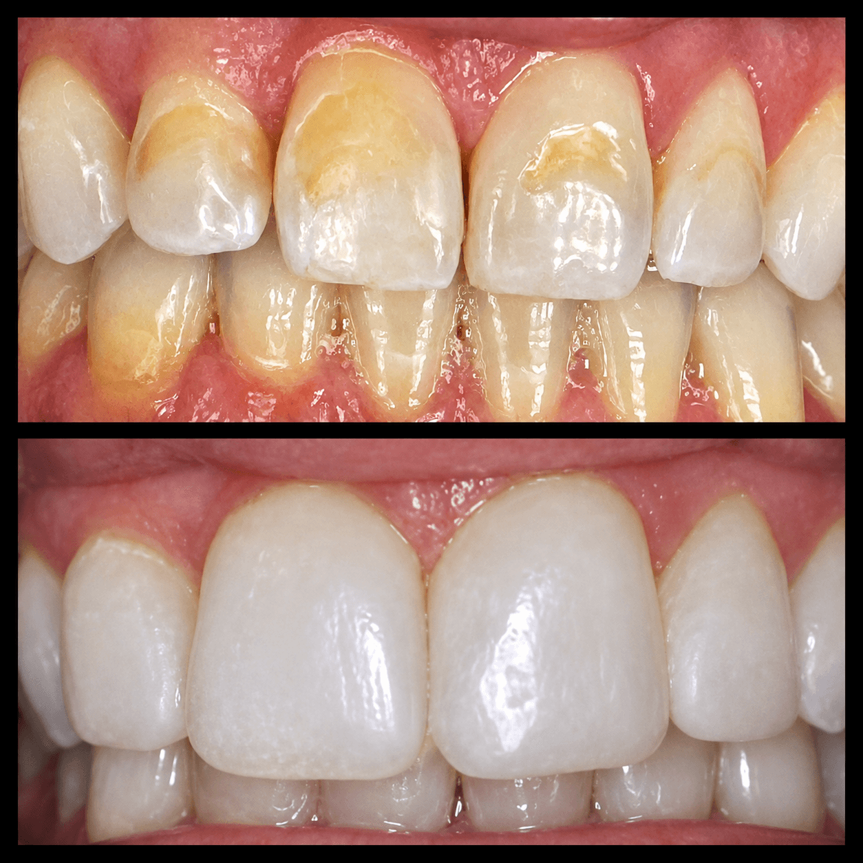 Dental Bonding Highlands Ranch