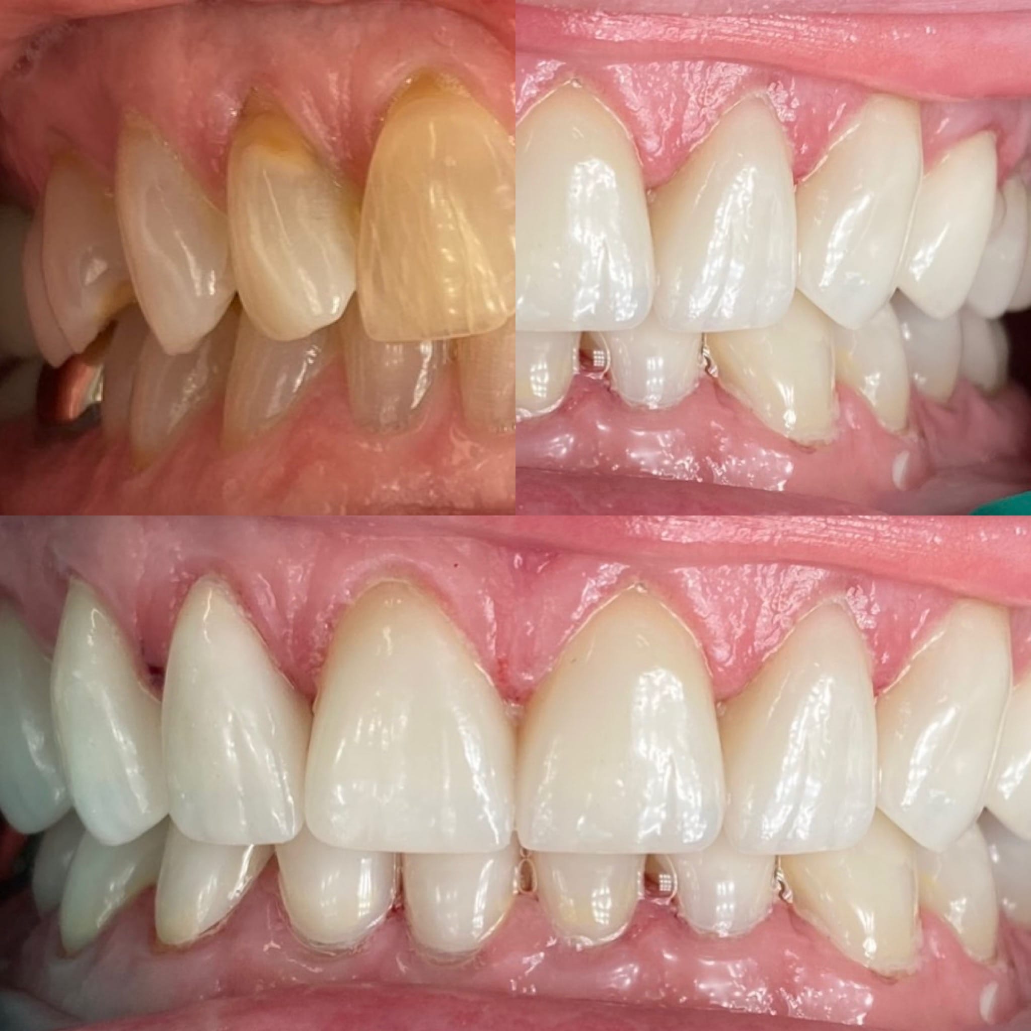 Teeth color before and after