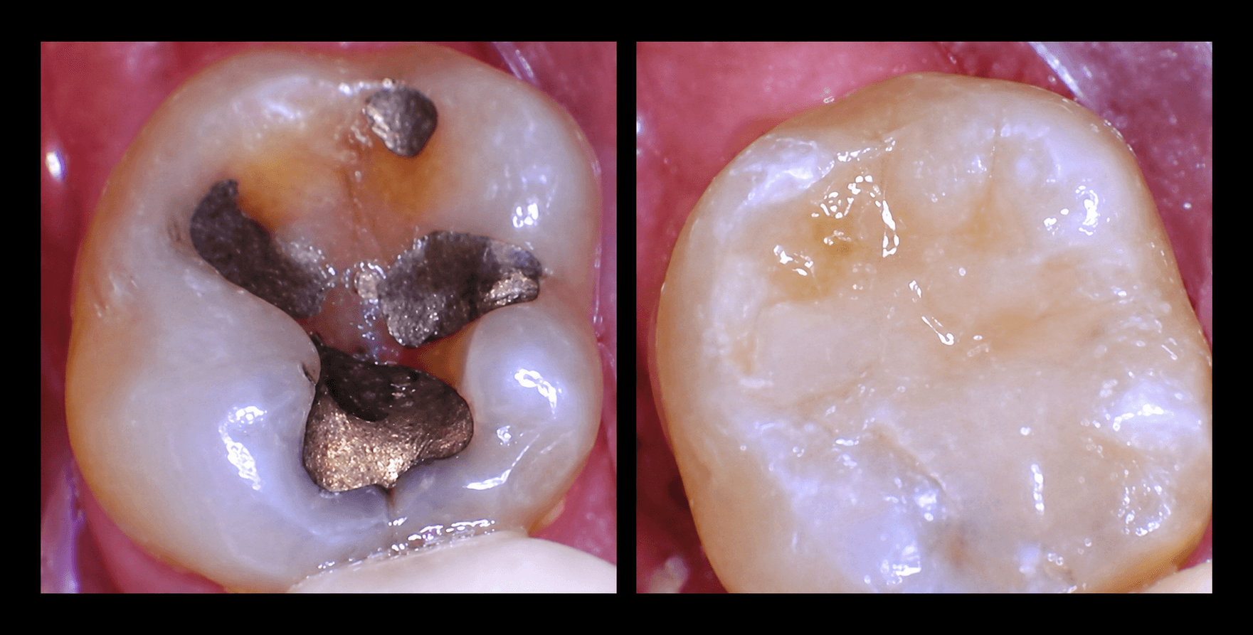 Tooth colored fillings Highlands Ranch